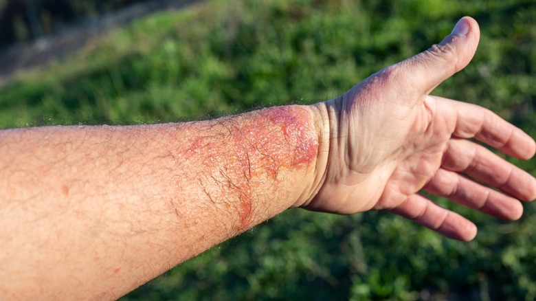 Arm with phytophotodermatitis