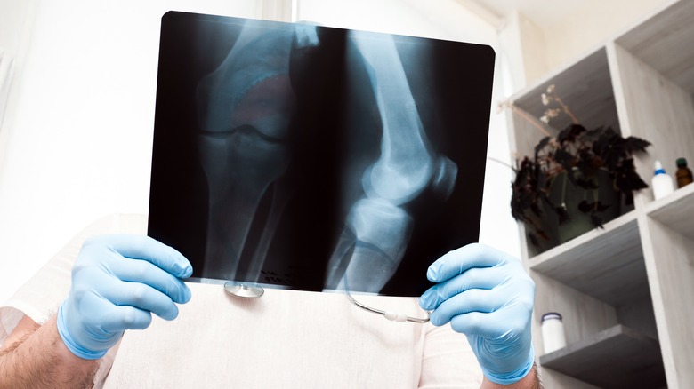 X-ray scan of bone and joint